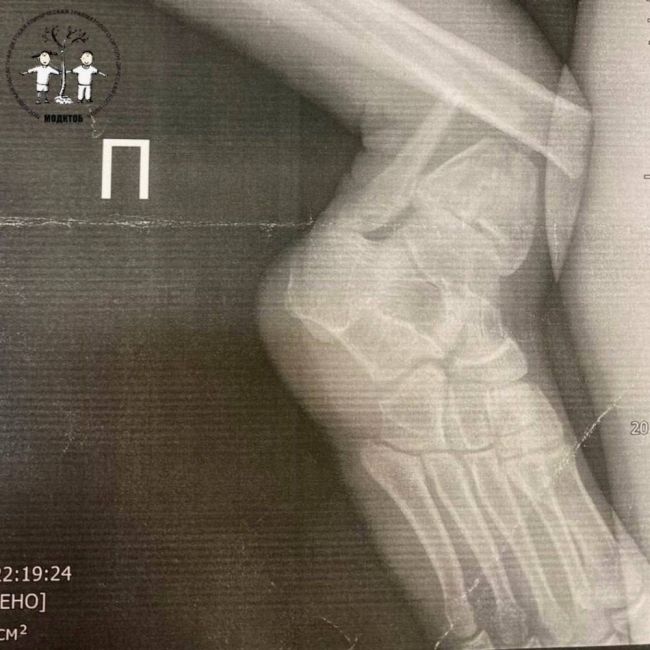 16-летний житель Подмосковья неудачно прыгнул с тарзанки в воду и получил сложный перелом ноги  Подросток был..