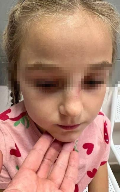 В Дрожжино женщина ударила 7-летнего ребёнка головой о карусель: у девочки сотрясение и сломан нос. 
7-летняя..