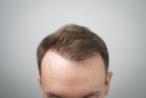 Артём пересадил волосы год назад в клинике пересадки волос HFE....  .. и результат превзошел все ожидания!  Его..