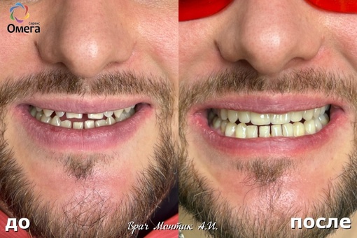 Ортопедическая стоматология: исправление формы зубов, дисколорит зубов (поверхностное изменение цвета..