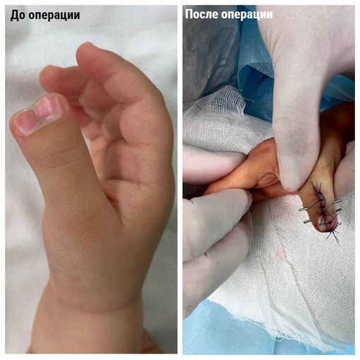 👨‍⚕В Подмосковье врачи прооперировали годовалого малыша с 6-ю пальцами на руке. 
В Московской областной..