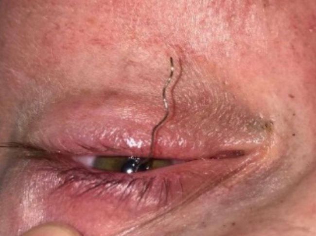 ❗️Тонким натурам лучше не смотреть.  В Истре врач спасла зрение 38-летнему мужчине с проволокой в глазу...